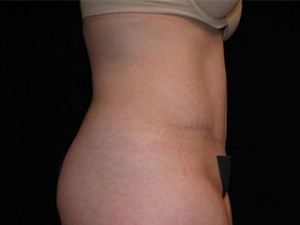 Abdominoplasty Before and After Pictures Glastonbury, CT