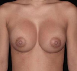 Breast Augmentation Before and After Pictures Glastonbury, CT