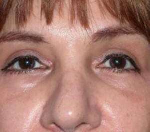 Eyelid Surgery Before and After Pictures Glastonbury, CT