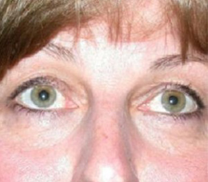 Eyelid Surgery Before and After Pictures Glastonbury, CT