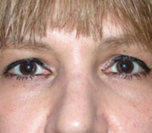 Eyelid Surgery Before and After Pictures Glastonbury, CT