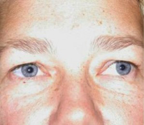 Eyelid Surgery Before and After Pictures Glastonbury, CT