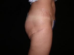 Thigh Lift Before and After Pictures Glastonbury, CT