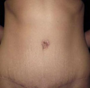 Tummy Tuck Before and After Pictures Glastonbury, CT