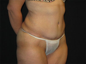 Abdominoplasty Before and After Pictures Glastonbury, CT