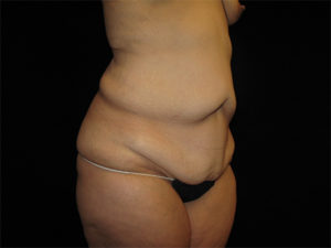 Abdominoplasty Before and After Pictures Glastonbury, CT