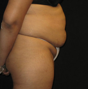 Abdominoplasty Before and After Pictures Glastonbury, CT