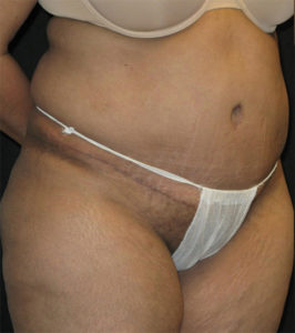 Abdominoplasty Before and After Pictures Glastonbury, CT