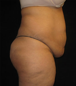 Abdominoplasty Before and After Pictures Glastonbury, CT