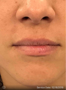 LIP AUGMENTATION BEFORE AND AFTER PICTURES GLASTONBURY, CT