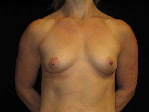 Breast Augmentation Before and After Pictures in Glastonbury, CT