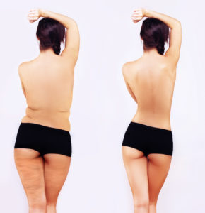 Liposuction in Glastonbury CT