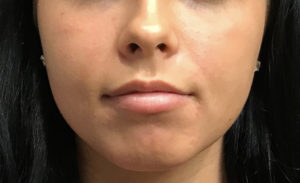 Lip Augmentation Before and After Pictures Glastonbury, CT