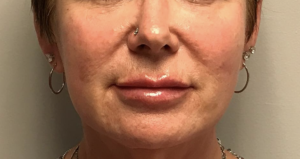 Lip Augmentation Before and After Pictures in Glastonbury, CT