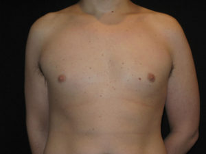 Gynecomastia Before and After Pictures Glastonbury, CT