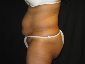 Abdominoplasty Before and After Pictures Glastonbury, CT