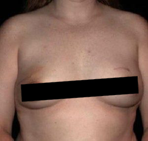 Breast Reconstruction Before and After Pictures Glastonbury, CT