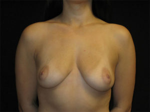 Breast Augmentation Before and After Pictures in Glastonbury, CT
