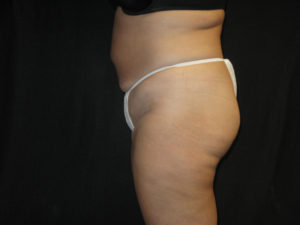 Liposuction Before and After Pictures Glastonbury, CT