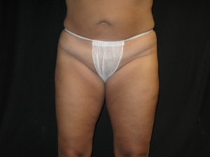 Liposuction Before and After Pictures Glastonbury, CT