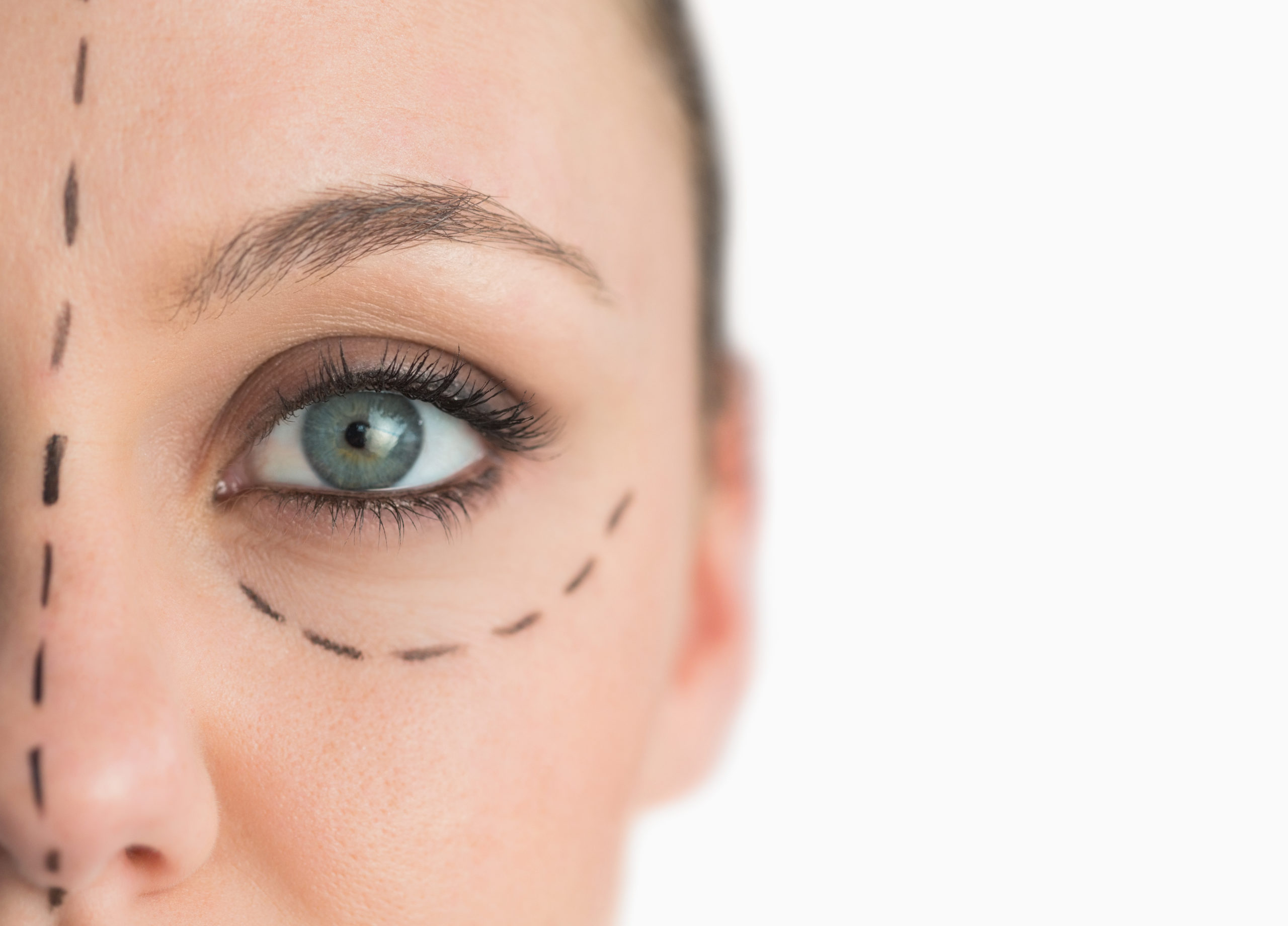 Blepharoplasty (Eyelid Surgery) in Glastonbury, CT